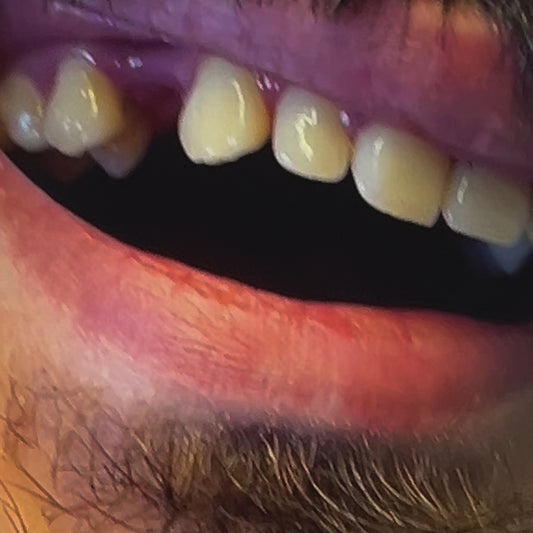 MISSING TOOTH GRILLZ